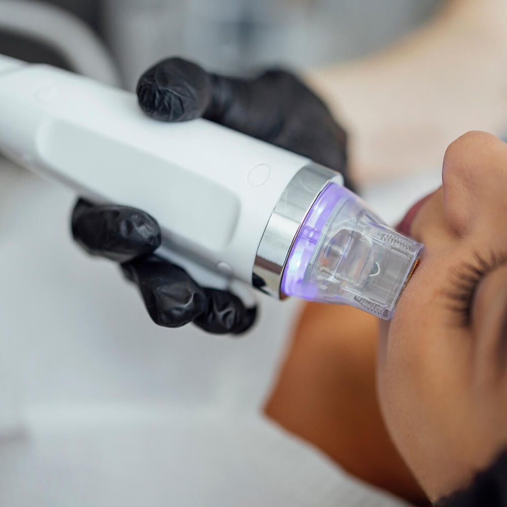 RF Лифтинг (Лицо)